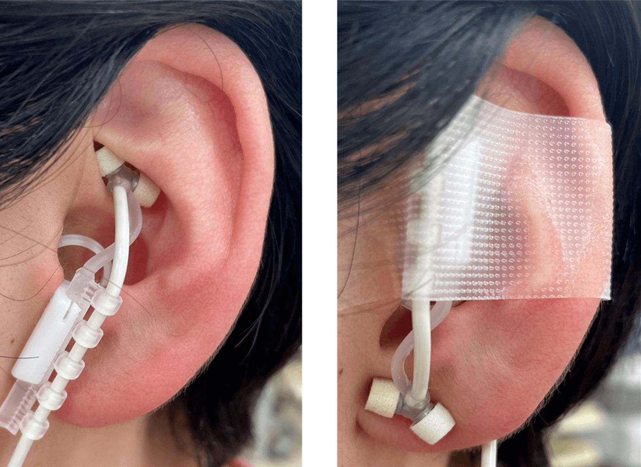 tVNS Therapy Device
